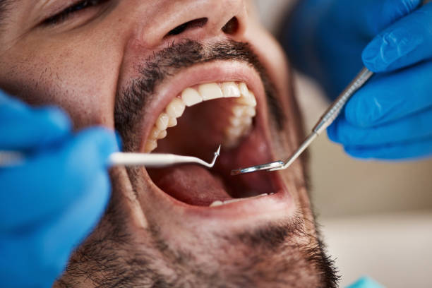 Best Emergency Dentist for Lost Fillings or Crowns in Southmayd, TX